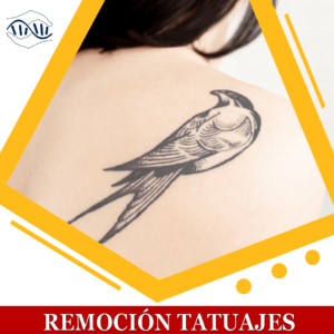 Imagen decorativa del tratamiento remocion de tatuajes